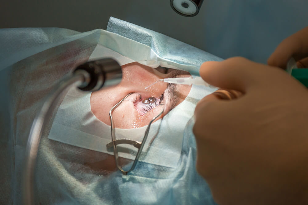 What Does Lasik Eye Correction Actually Change In The Cornea?