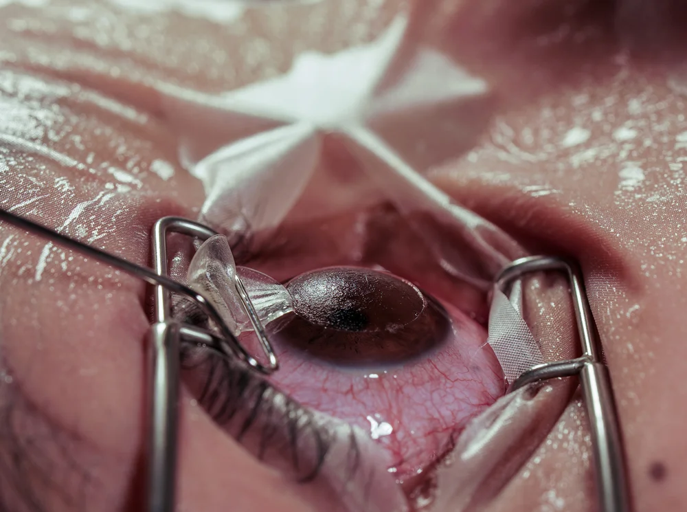A Typical Surgery Lasik Consultation Covers These Key Steps

The current image has no alternative text. The file name is: Lasik-Eye-Surgery-1-1024x640-1.jpeg
Replace

